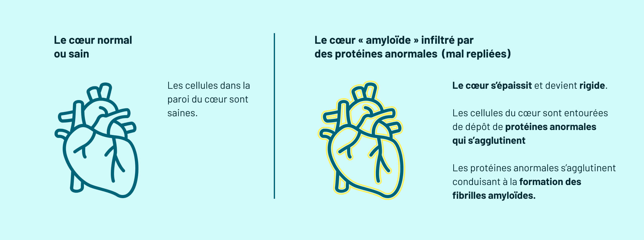 Qu’est-ce-que l’amylose cardiaque ?